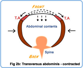 Contracted transversus abdominis